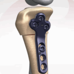 Tibial plateau with stabilization plate after CCWO surgery