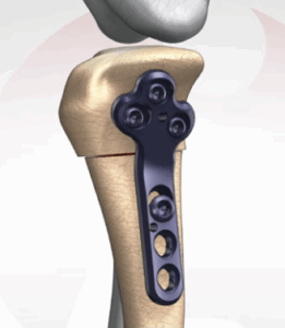 Tibial plateau with stabilization plate after CCWO surgery