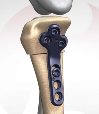 Tibial plateau with stabilization plate after CCWO surgery