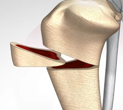 CCWO surgery technique showing tibial wedge osteotomy for cruciate repair